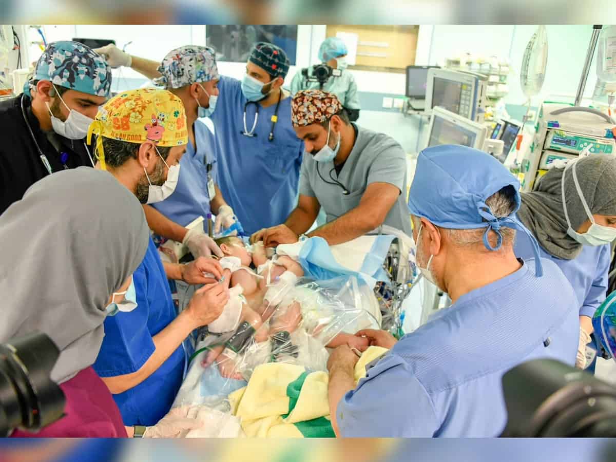 Iraqi conjoined twins successfully separated in 11-hr surgery